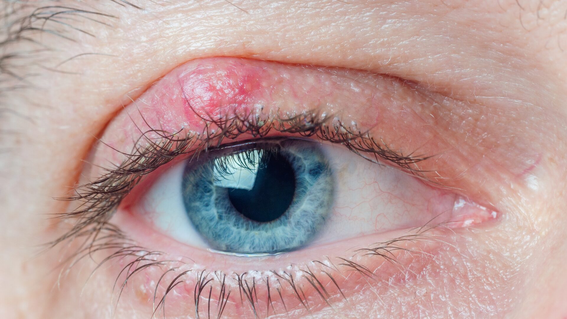 Chirurgia palpebrale ambulatoriale Brescia - Dott. Zanolini