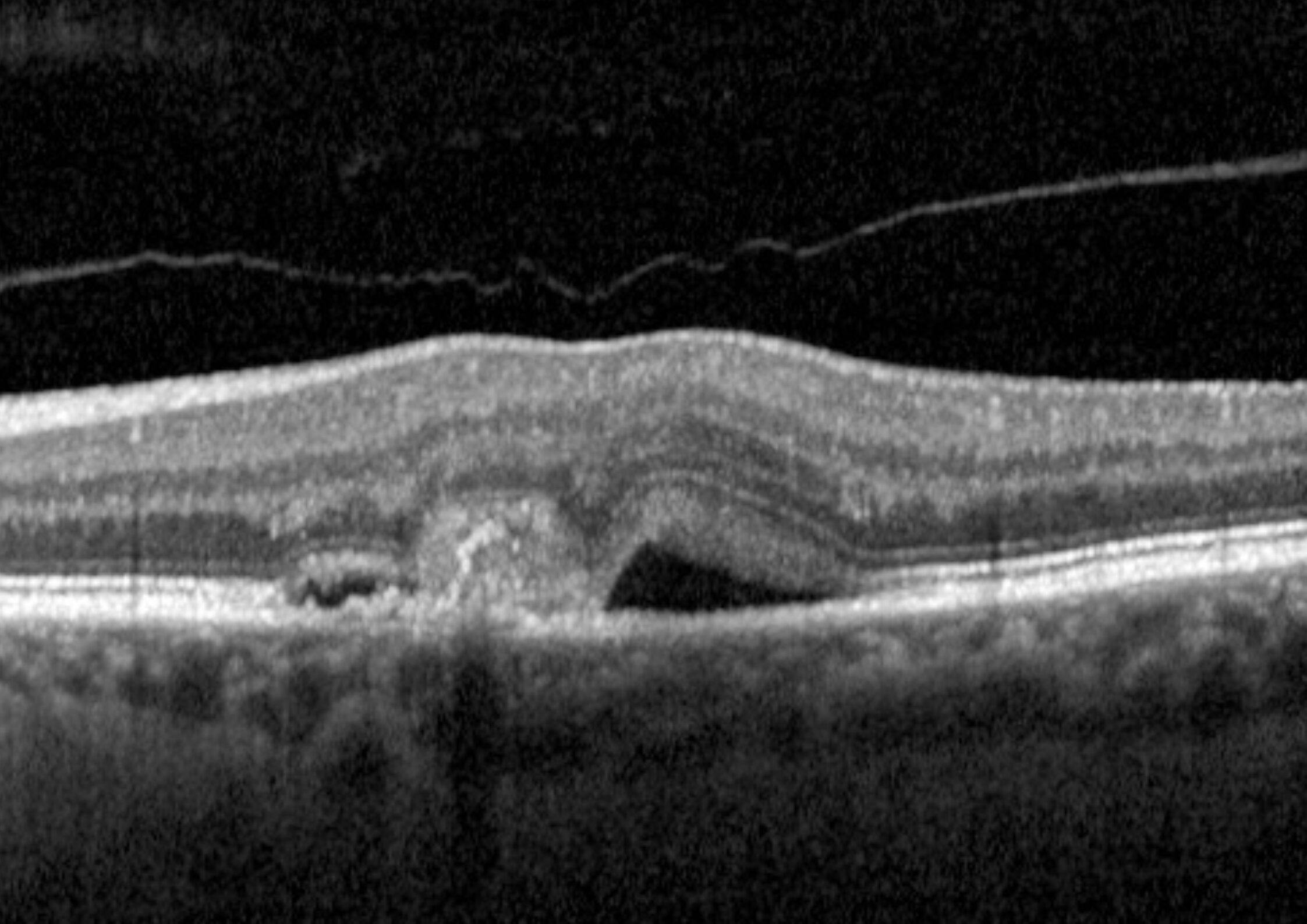 Iniezioni intravitreali