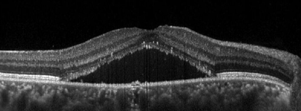 Screenshot 2025-12-08 alle 01.19.56 Corioretinopatia Sierosa Centrale: Sintomi e Trattamenti