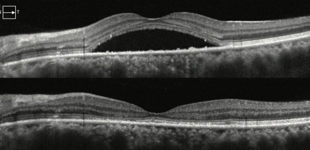 Screenshot 2025-12-08 alle 02.06.23 Corioretinopatia Sierosa Centrale: Sintomi e Trattamenti