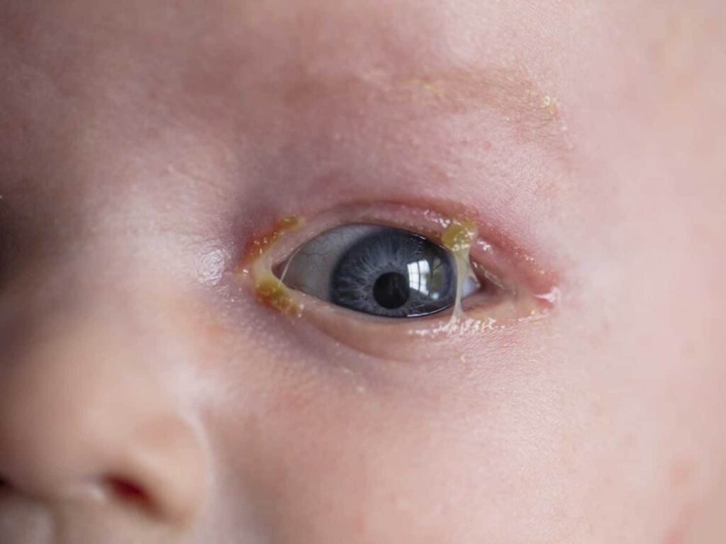 Stenosi congenita del dotto nasolacrimale