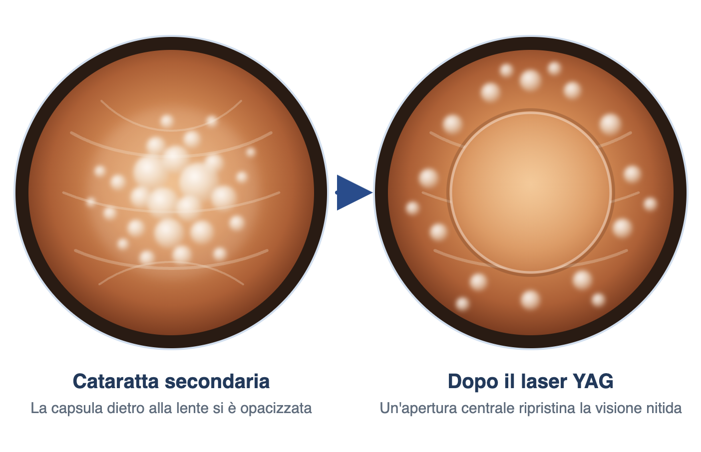 Cataratta secondaria in retroilluminazione, prima e dopo la capsulotomia con laser YAG