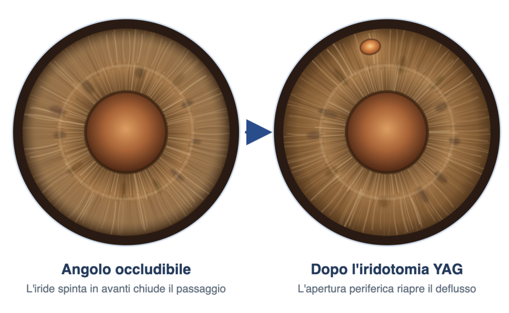 Iridotomia YAG laser per glaucoma