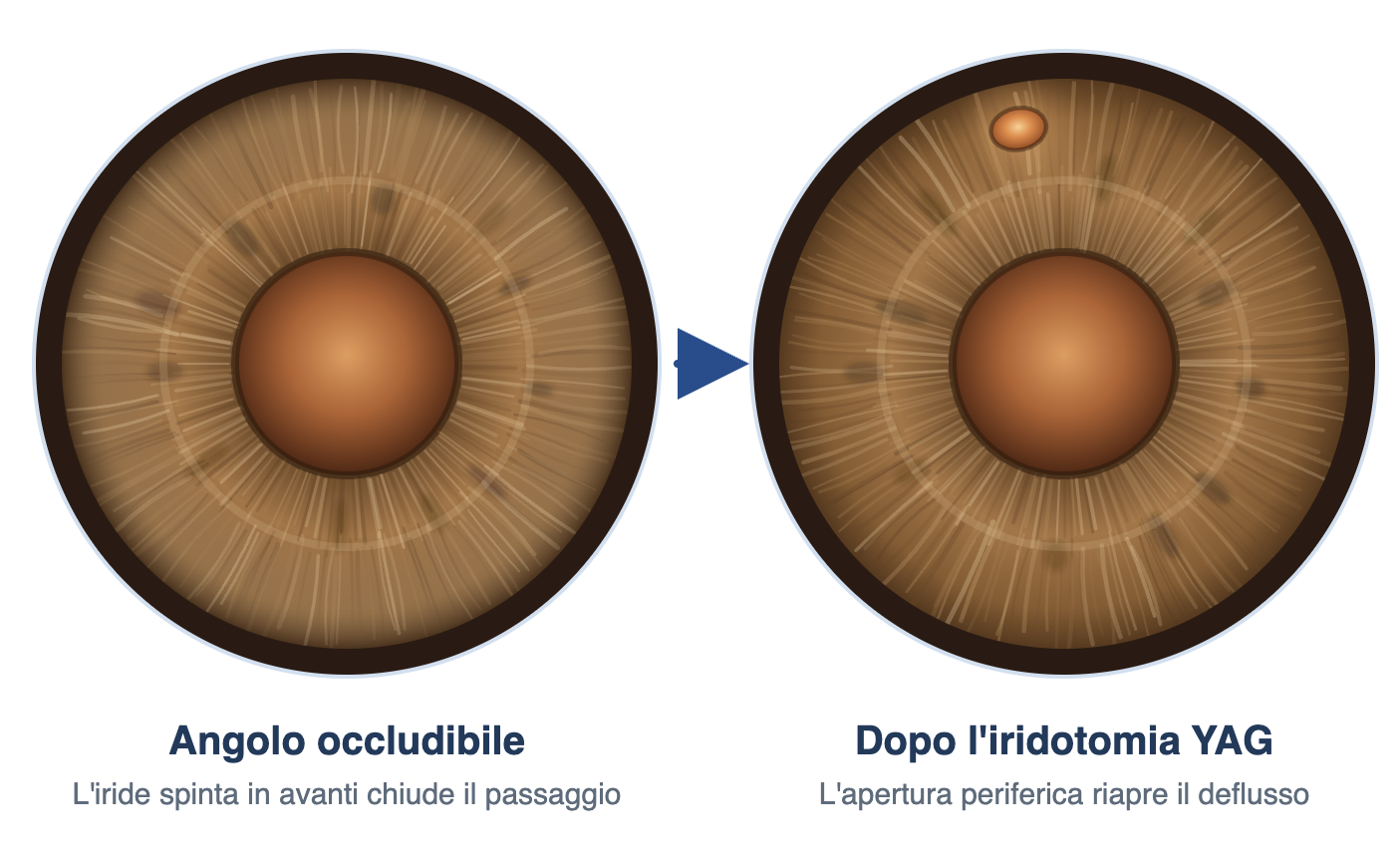 Iridotomia YAG laser per glaucoma
