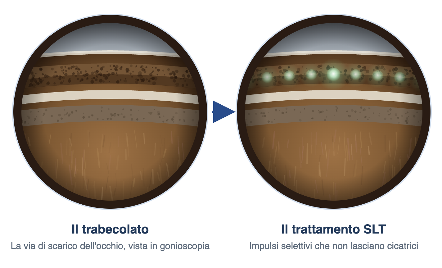 Trabeculoplastica laser selettiva SLT per glaucoma