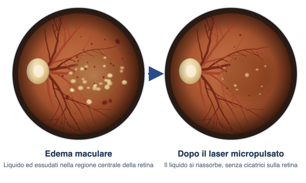 Laser microplusato giallo per edema maculare
