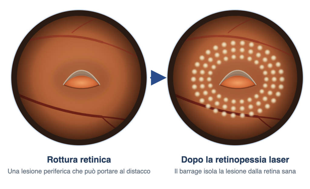 Retinopessia laser per rotture retiniche