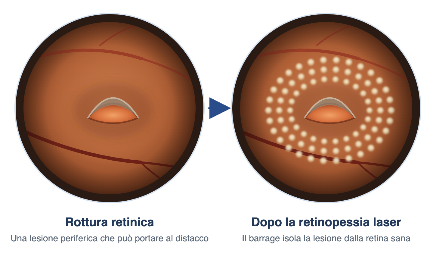 Retinopessia laser per rotture retiniche
