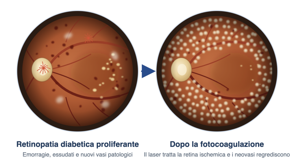 Fotocoagulazione retinica per retinopatia diabetica