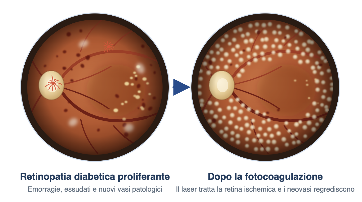 Fotocoagulazione retinica per retinopatia diabetica