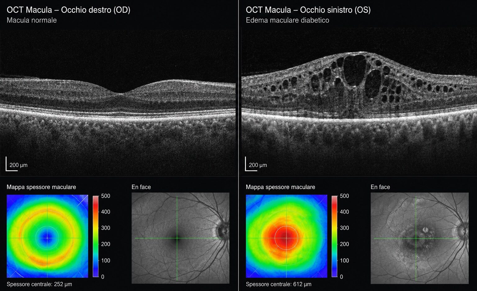 OCT maculare con retina normale a sinistra ed edema maculare diabetico a destra