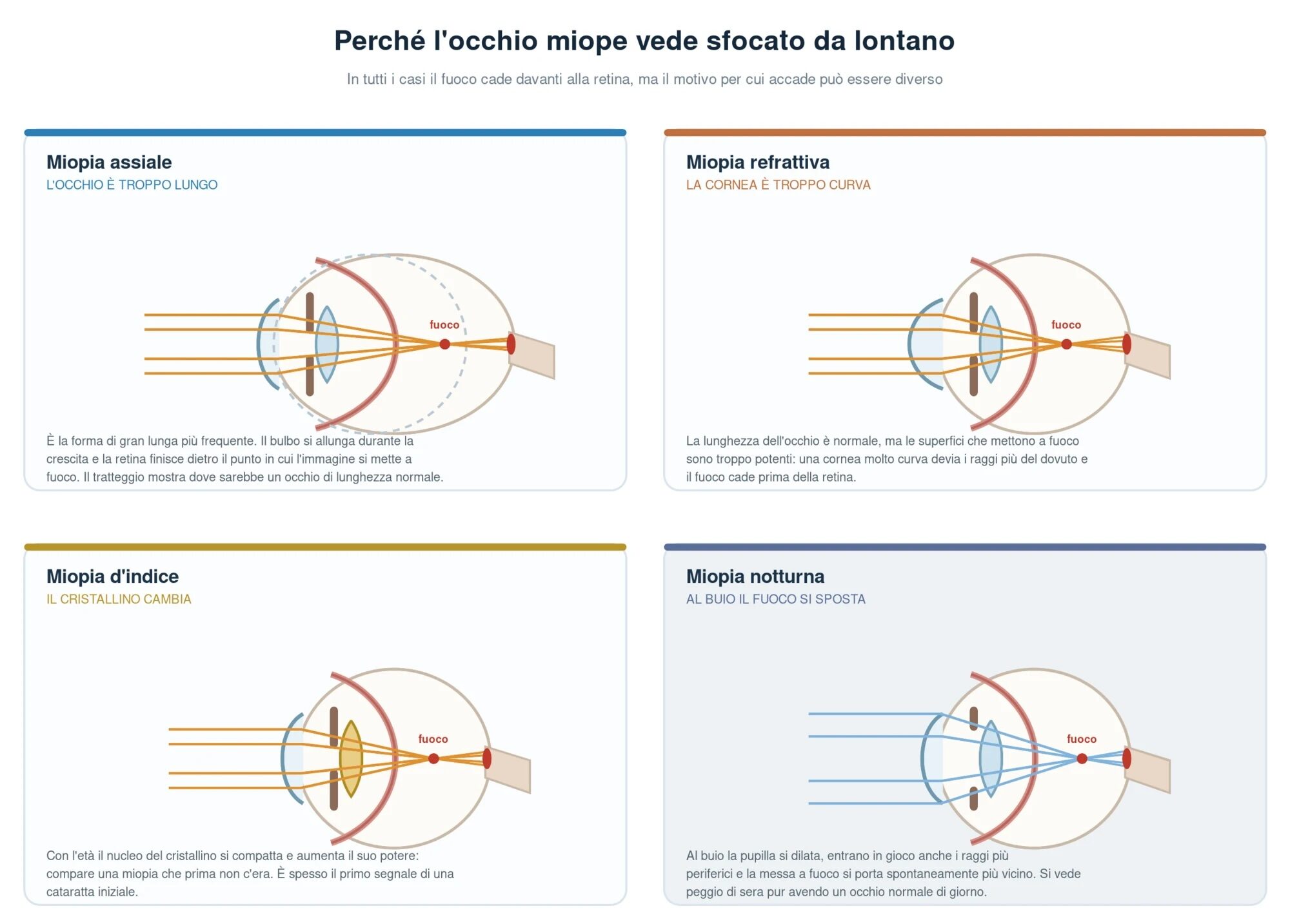 I quattro meccanismi della miopia a confronto: assiale con occhio troppo lungo, refrattiva con cornea troppo curva, d'indice per aumento del potere del cristallino e notturna per dilatazione della pupilla al buio; in tutti i casi il fuoco cade davanti alla retina