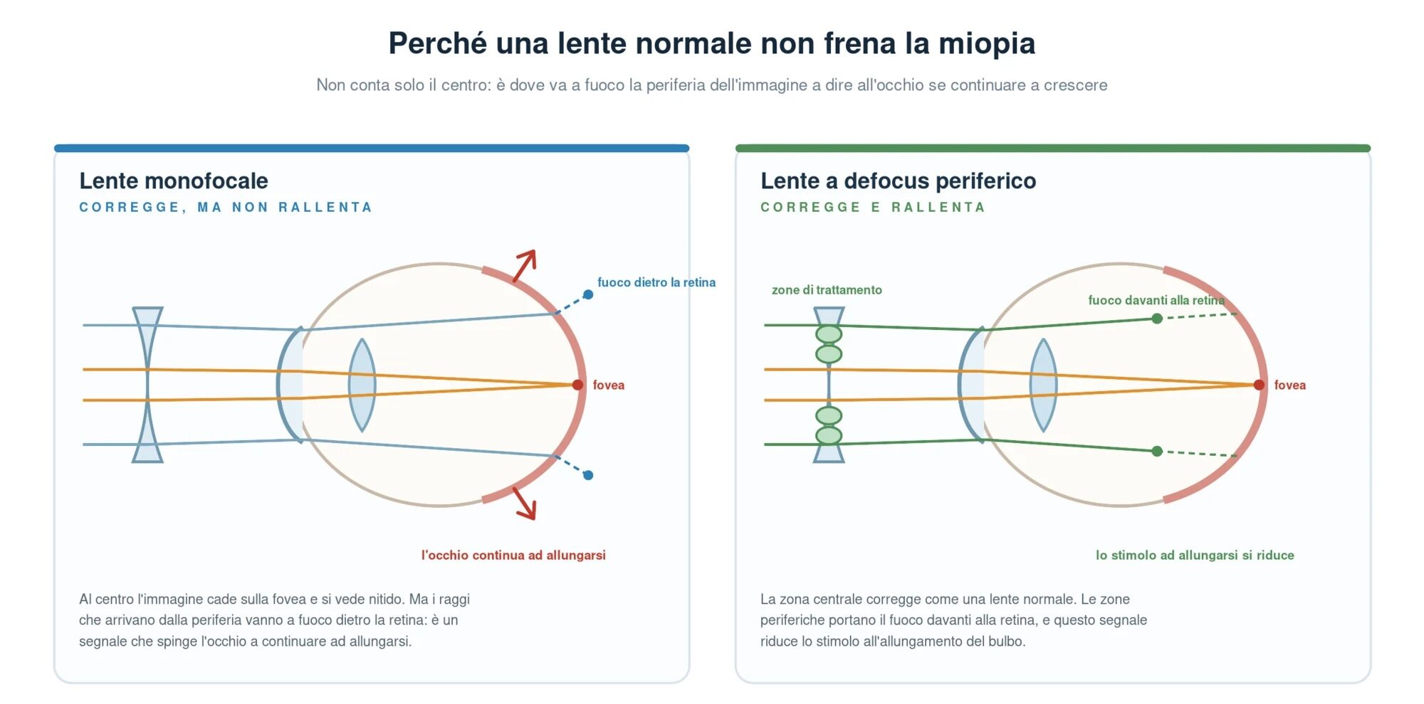 Confronto fra lente monofocale e lente a defocus periferico nel controllo della miopia: con la lente normale i raggi periferici vanno a fuoco dietro la retina e l'occhio continua ad allungarsi, con la lente a defocus le zone periferiche portano il fuoco davanti alla retina e lo stimolo all'allungamento si riduce