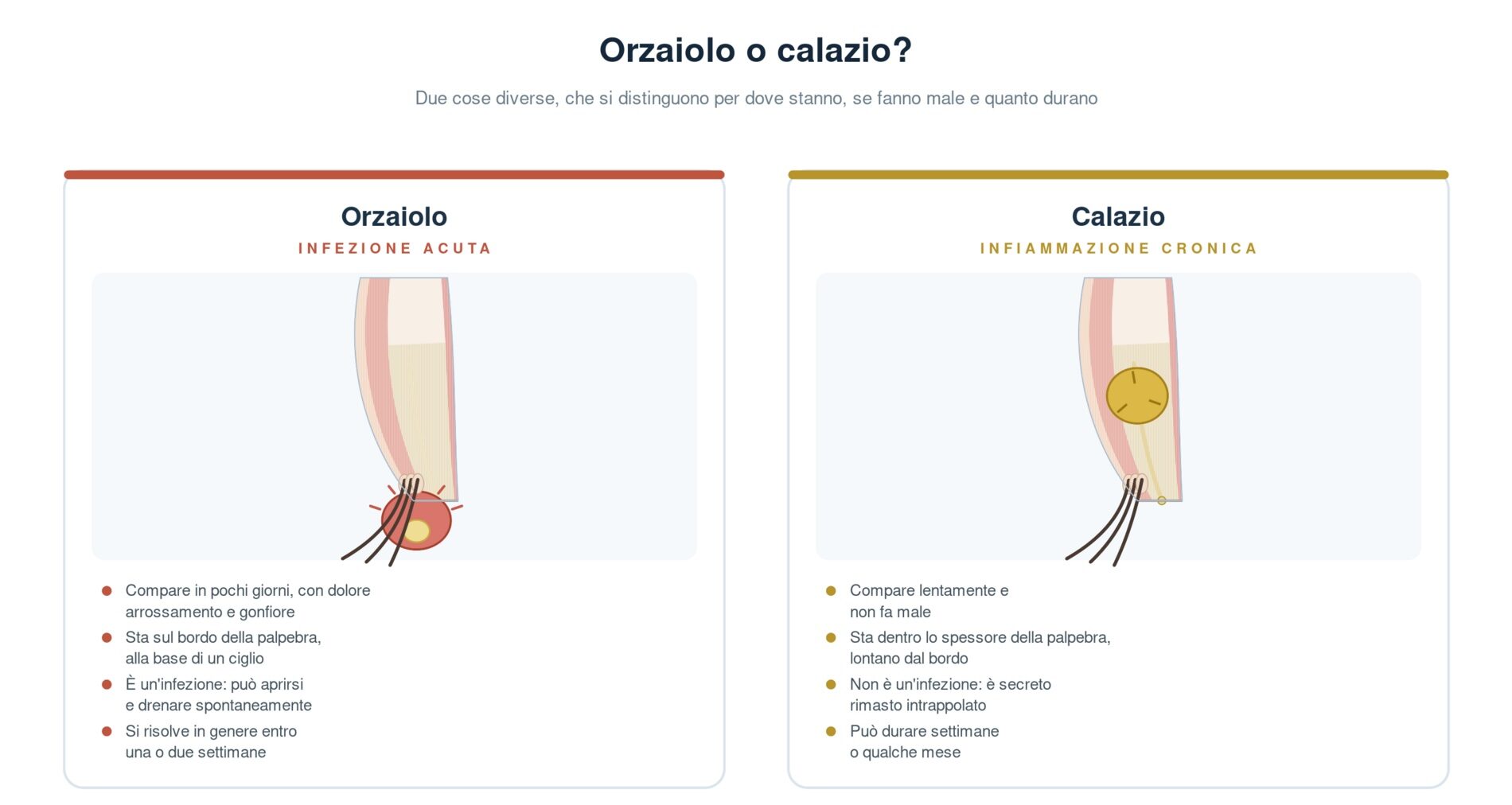 Confronto in sezione fra orzaiolo e calazio: l'orzaiolo è una tumefazione arrossata e dolente sul bordo della palpebra, alla base di un ciglio, che può drenare spontaneamente; il calazio è un nodulo indolore situato dentro lo spessore della palpebra, lontano dal bordo, dovuto a secreto rimasto intrappolato nella ghiandola