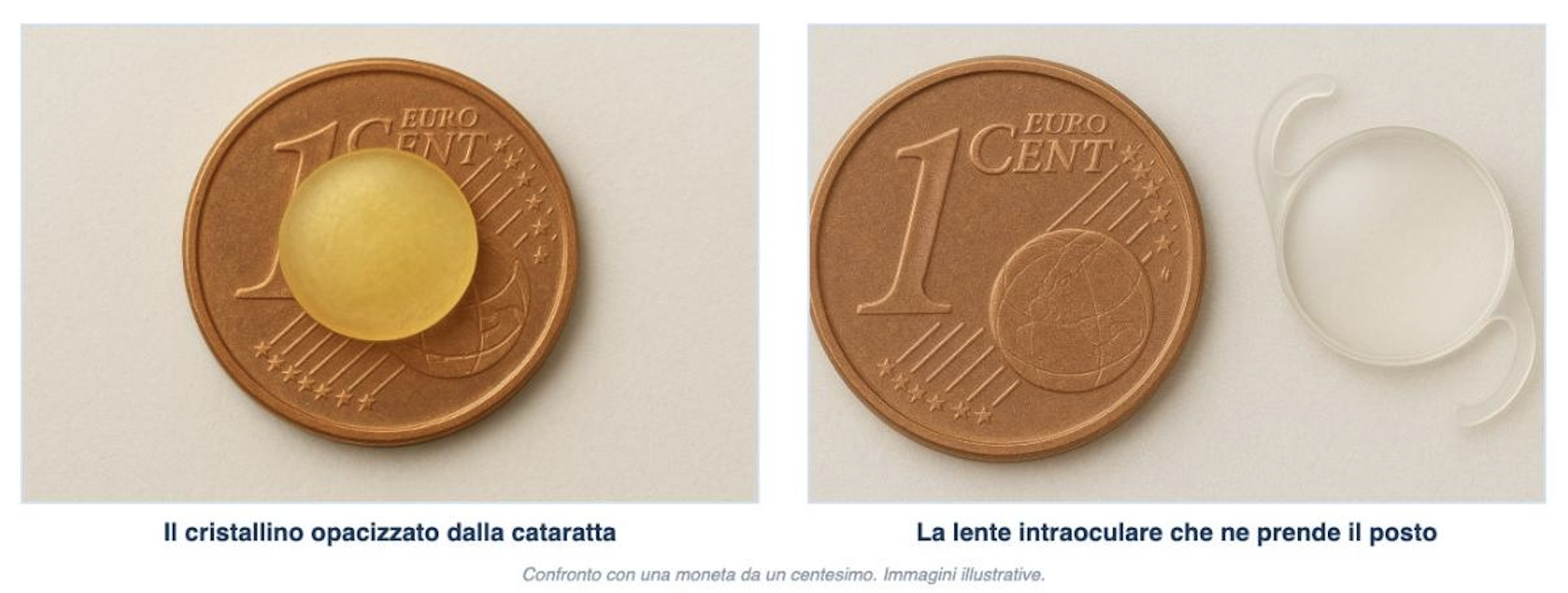 Il cristallino opacizzato dalla cataratta e la lente intraoculare che ne prende il posto, a confronto con una moneta da un centesimo. Immagini illustrative.