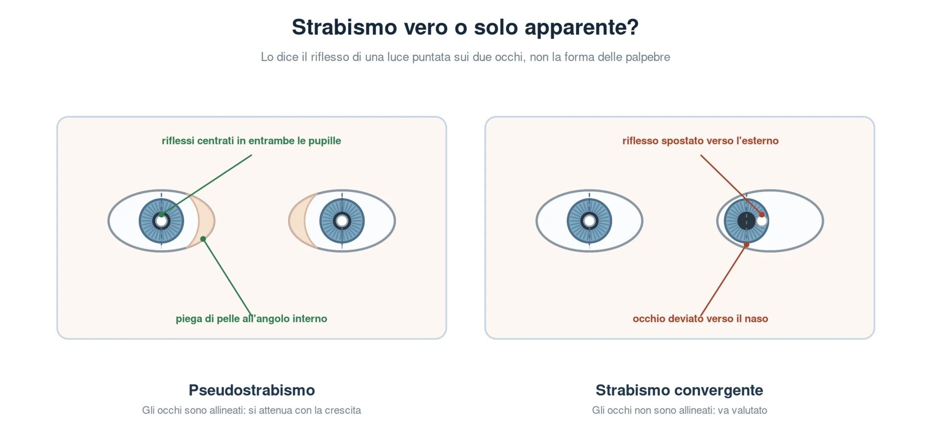 Confronto fra pseudostrabismo e strabismo convergente: a sinistra la piega di pelle all'angolo interno copre il bianco verso il naso ma i riflessi luminosi sono centrati in entrambe le pupille, a destra un occhio è realmente deviato verso il naso e il riflesso appare spostato verso l'esterno
