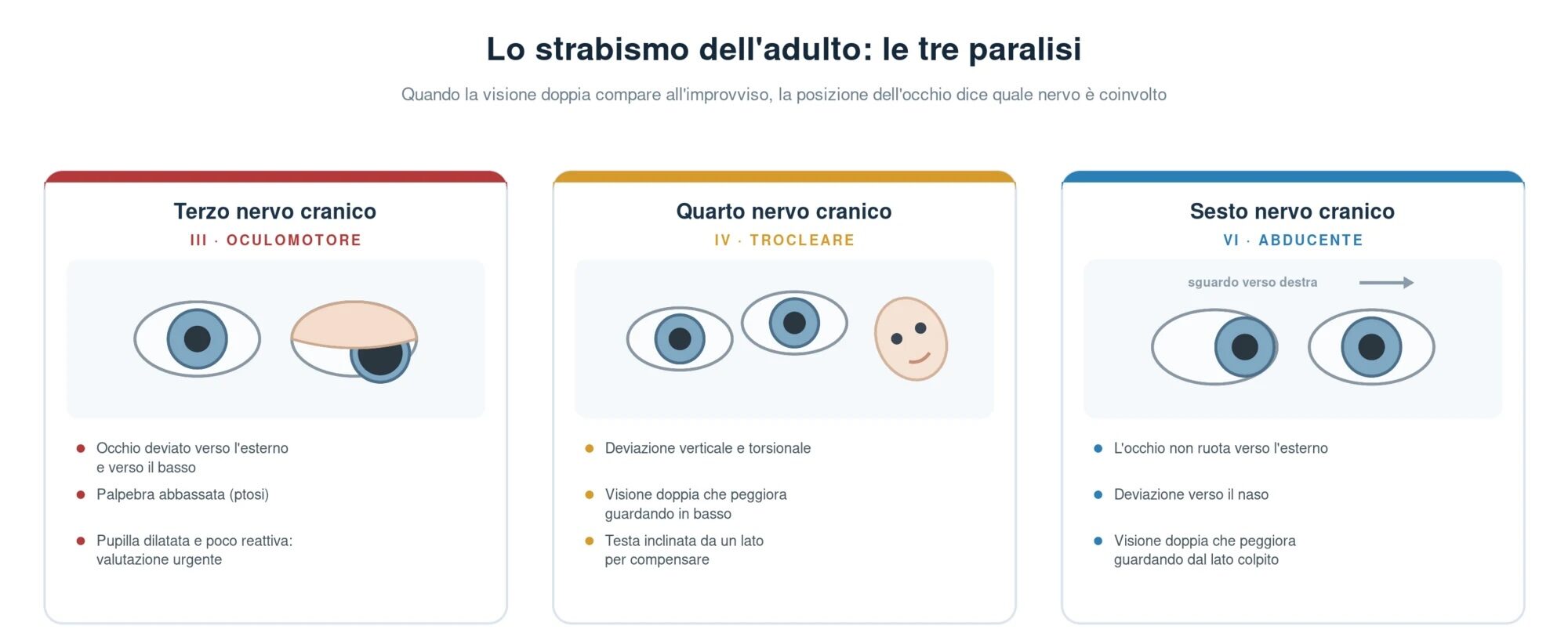 Schema delle tre paralisi dei nervi oculomotori nell'adulto: terzo nervo con occhio deviato verso l'esterno e il basso, palpebra abbassata e pupilla dilatata; quarto nervo con deviazione verticale e testa inclinata per compensare; sesto nervo con occhio che non ruota verso l'esterno