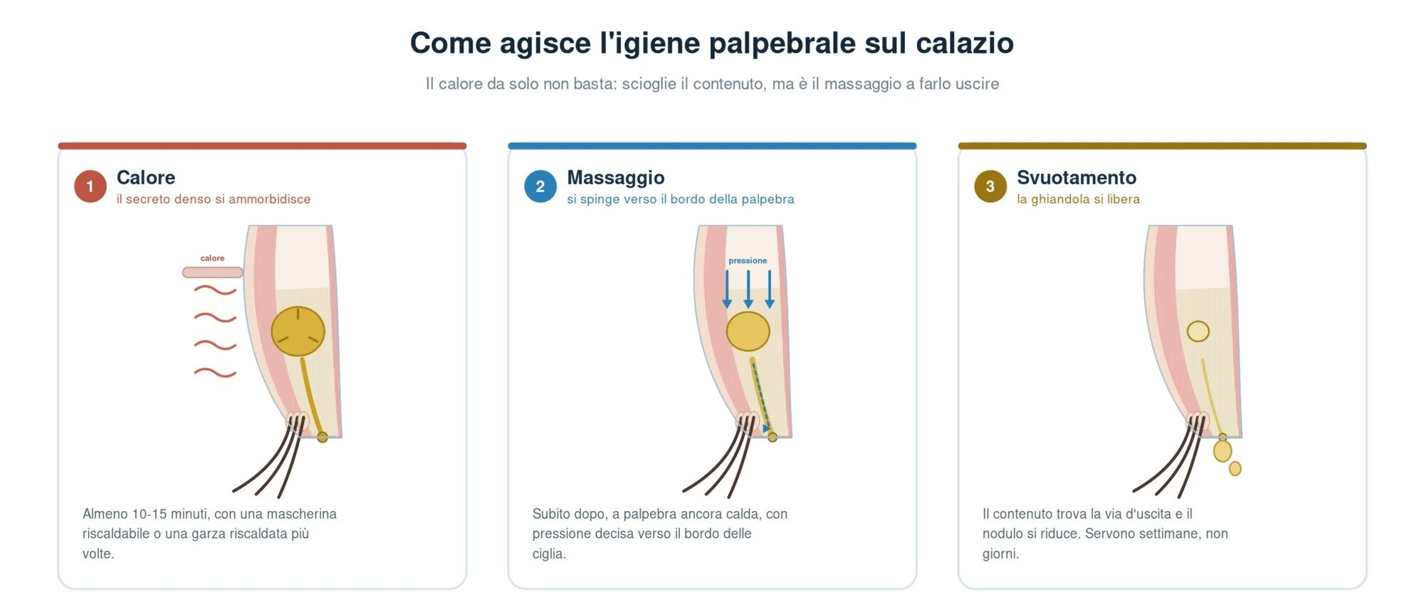 Schema in tre fasi di come agisce l'igiene palpebrale sul calazio: il calore ammorbidisce il secreto denso intrappolato nella ghiandola, il massaggio lo spinge verso il bordo della palpebra, la ghiandola si svuota attraverso lo sbocco e il nodulo si riduce