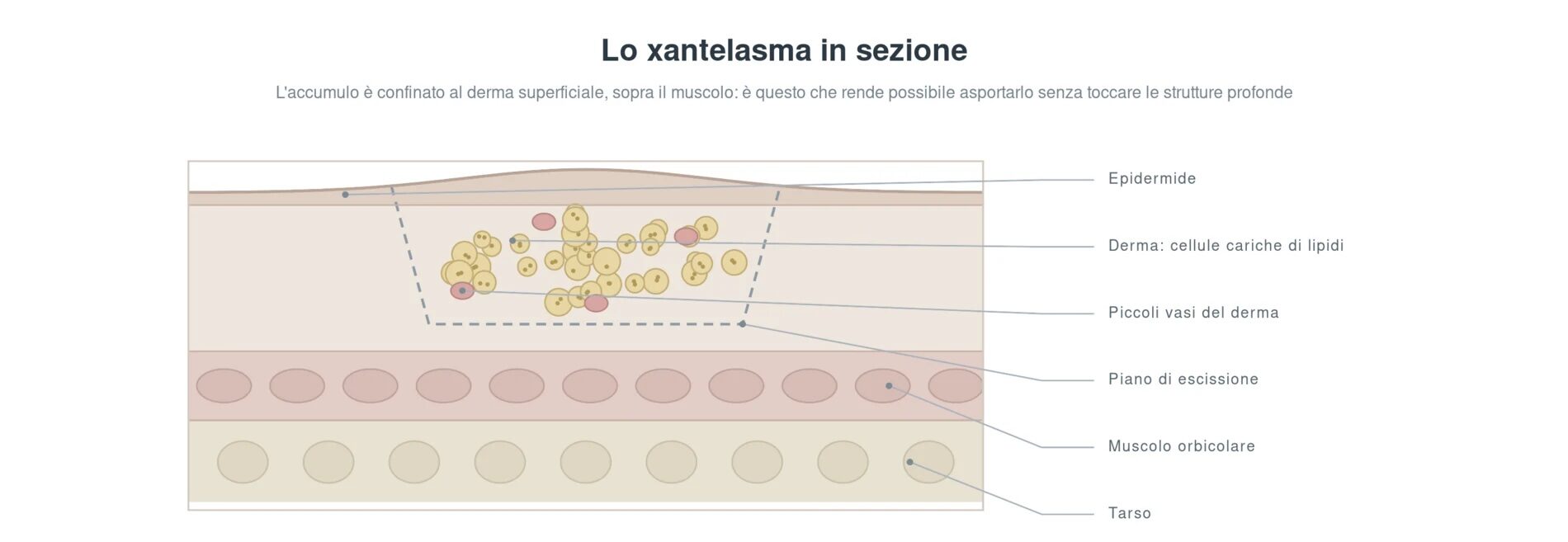 Sezione della palpebra con xantelasma: le cellule cariche di lipidi si accumulano nel derma superficiale attorno ai piccoli vasi, al di sopra del muscolo orbicolare e del tarso, con indicazione del piano di escissione