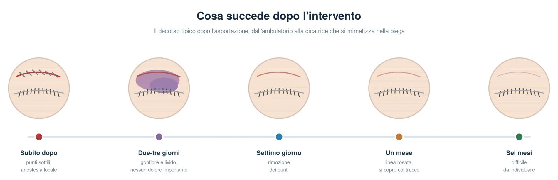 Decorso dopo l'asportazione degli xantelasmi in cinque momenti: sutura sottile lungo la piega palpebrale il giorno dell'intervento, gonfiore e livido dopo due-tre giorni, rimozione dei punti al settimo giorno, linea rosata a un mese, cicatrice difficile da individuare a sei mesi
