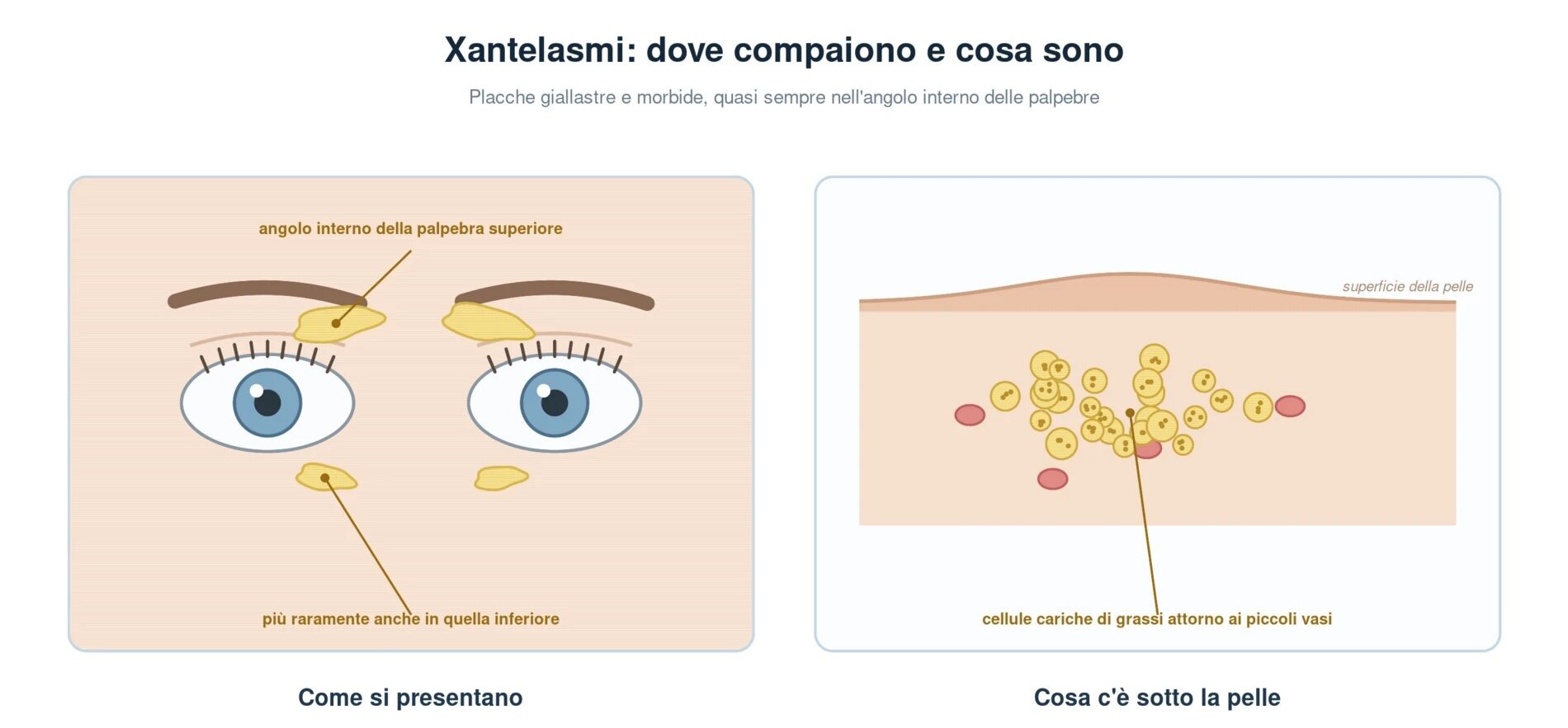 Xantelasmi sulle palpebre: placche giallastre nell'angolo interno della palpebra superiore e, più raramente, di quella inferiore; in sezione la pelle mostra l'accumulo di cellule cariche di grassi attorno ai piccoli vasi del derma