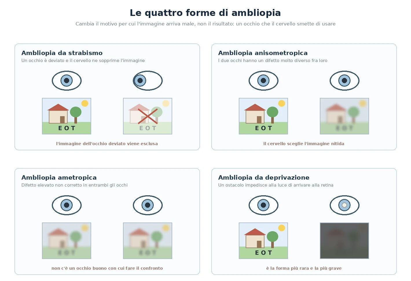 Schema delle quattro forme di ambliopia: da strabismo, con l'immagine dell'occhio deviato soppressa; anisometropica, con un occhio a fuoco e l'altro sfocato; ametropica, con entrambi gli occhi che ricevono un'immagine sfocata; da deprivazione, con un ostacolo che impedisce alla luce di raggiungere la retina