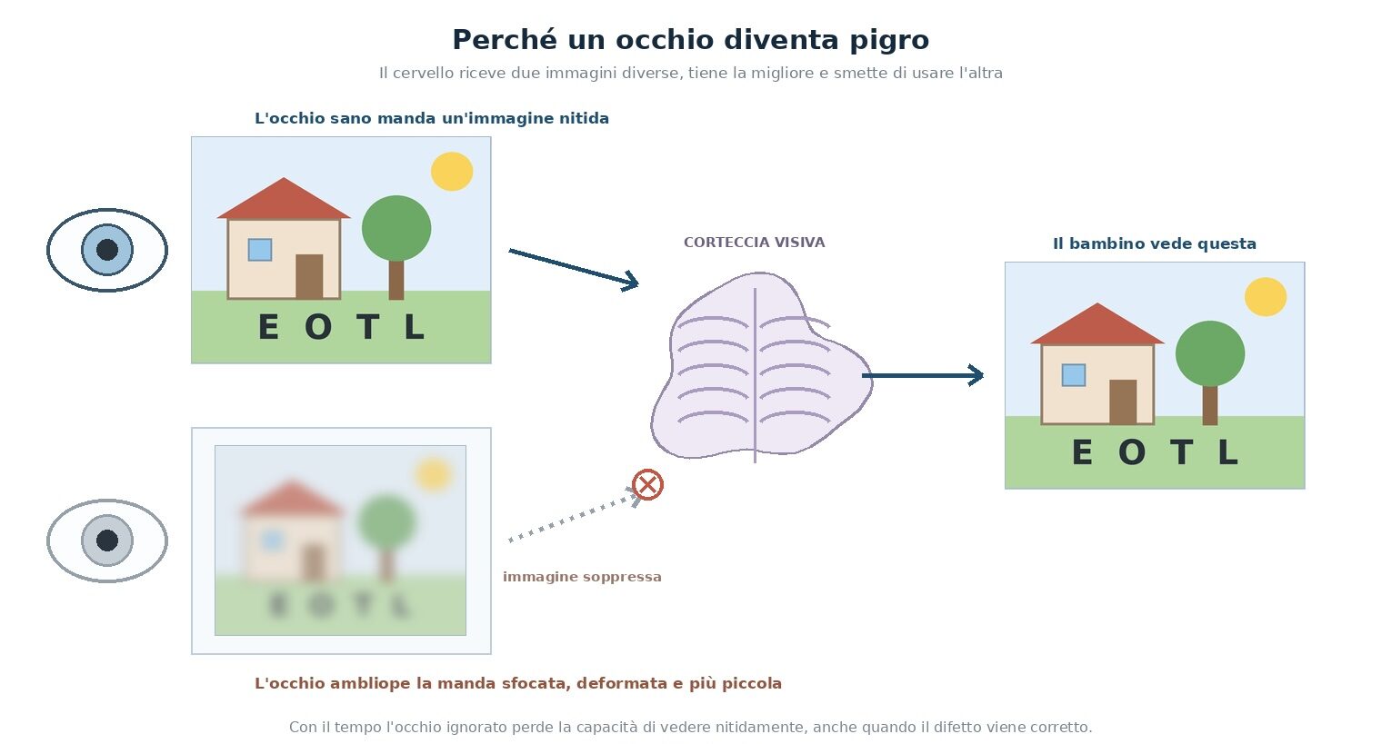 Schema del meccanismo dell'ambliopia: l'occhio sano invia alla corteccia visiva un'immagine nitida, l'occhio ambliope invia la stessa scena sfocata, deformata e più piccola; il cervello utilizza solo l'immagine nitida e sopprime l'altra, per cui il bambino vede bene e non si accorge del problema