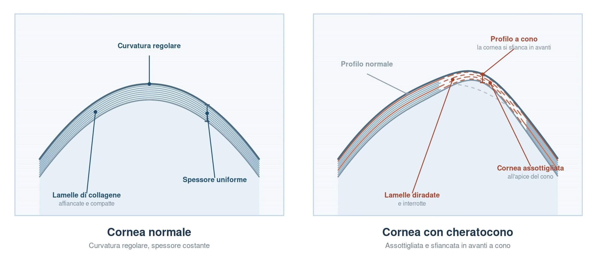 Sezione della cornea a confronto: a sinistra cornea normale con curvatura regolare, spessore uniforme e lamelle di collagene affiancate e compatte; a destra cornea con cheratocono, sfiancata in avanti a cono, assottigliata all'apice e con lamelle di collagene diradate e interrotte