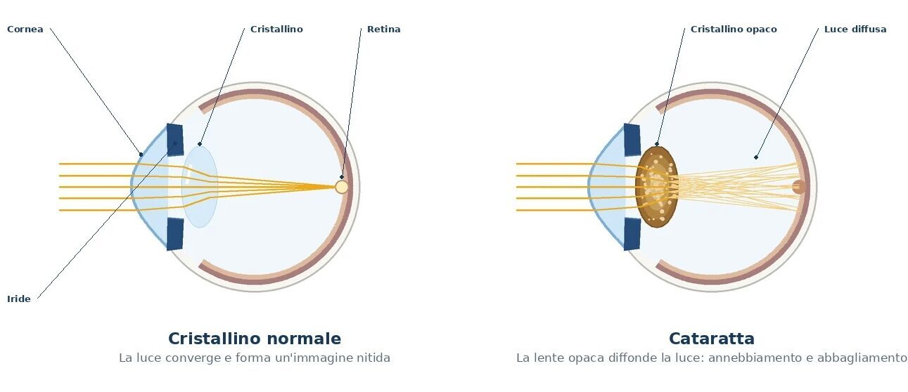 Sezione schematica dell'occhio: a sinistra il cristallino trasparente fa convergere la luce sulla retina, a destra il cristallino opacizzato dalla cataratta la diffonde
