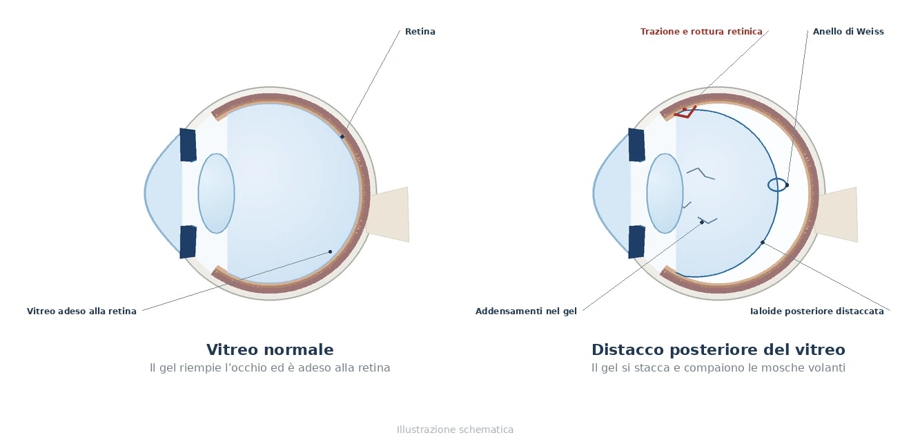 Sezione schematica dell'occhio: a sinistra il vitreo adeso alla retina, a destra il distacco posteriore del vitreo con anello di Weiss, addensamenti e trazione periferica