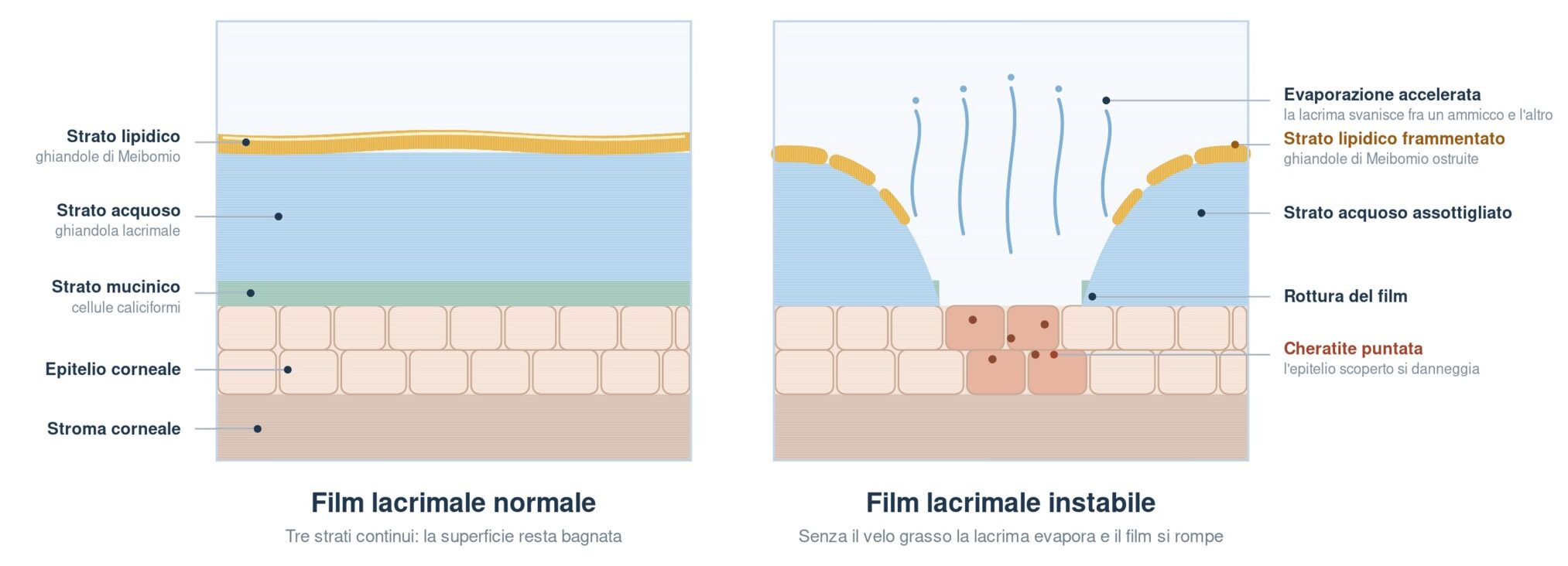 Struttura del film lacrimale: a sinistra film normale con strato lipidico, acquoso e mucinico continui; a destra film instabile nell'occhio secco, con strato lipidico frammentato, evaporazione accelerata, rottura del film e cheratite puntata sull'epitelio corneale scoperto