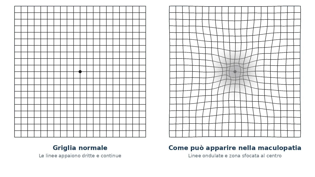 Griglia di Amsler normale a confronto con come appare nella maculopatia: linee ondulate e area sfocata al centro