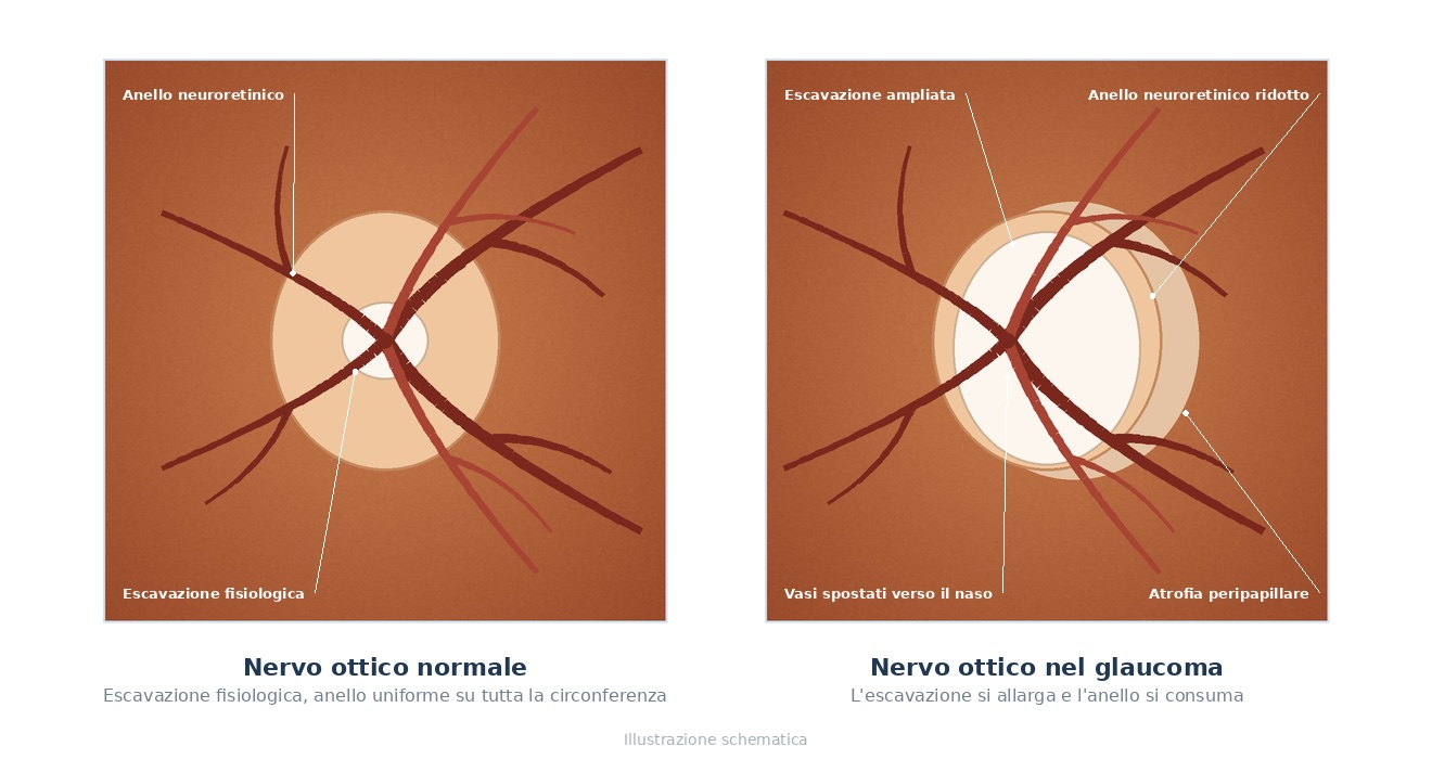 Confronto schematico fra un nervo ottico normale e un nervo ottico nel glaucoma: escavazione ampliata, anello neuroretinico ridotto e atrofia peripapillare