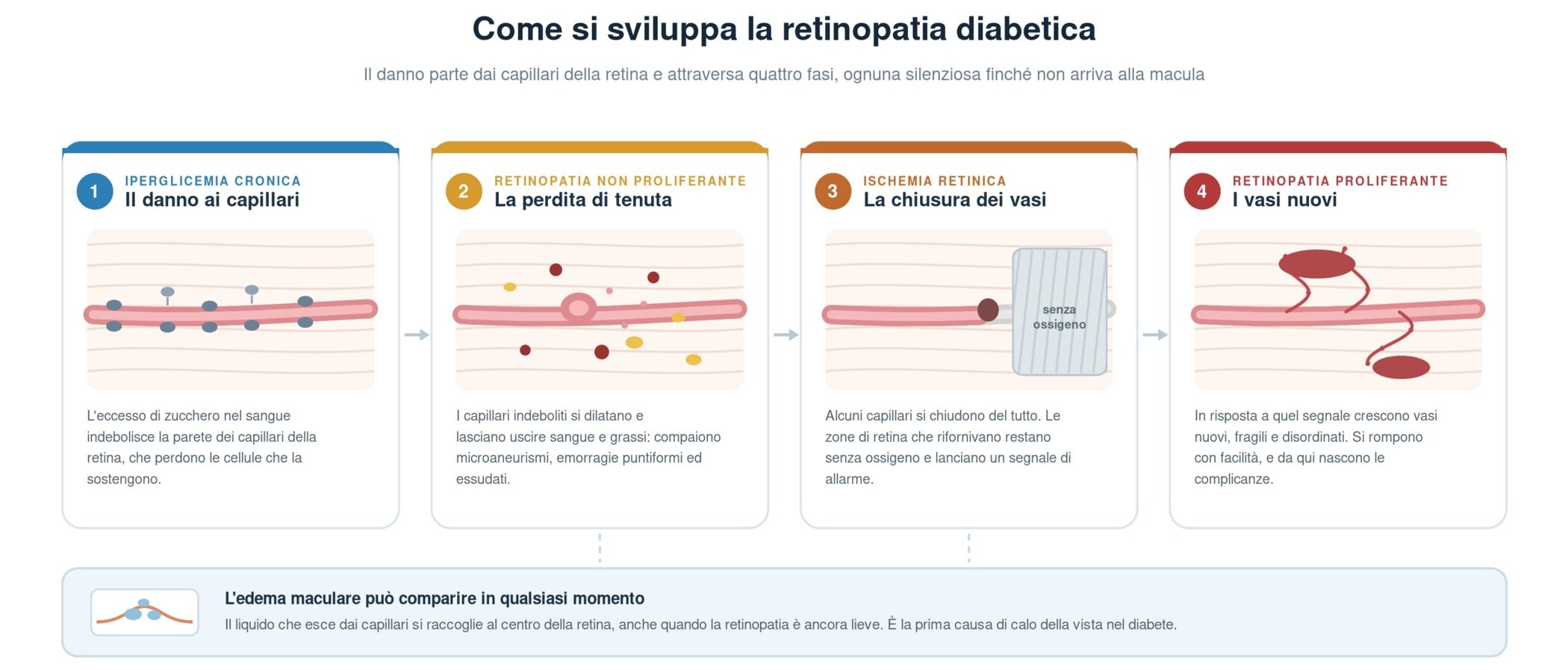 Schema in quattro fasi dello sviluppo della retinopatia diabetica: l'iperglicemia cronica indebolisce la parete dei capillari retinici, i capillari perdono tenuta con microaneurismi, emorragie ed essudati, alcuni vasi si chiudono lasciando zone di retina senza ossigeno e infine crescono vasi nuovi e fragili; l'edema maculare può comparire in qualsiasi fase